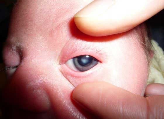 Cataract in Children