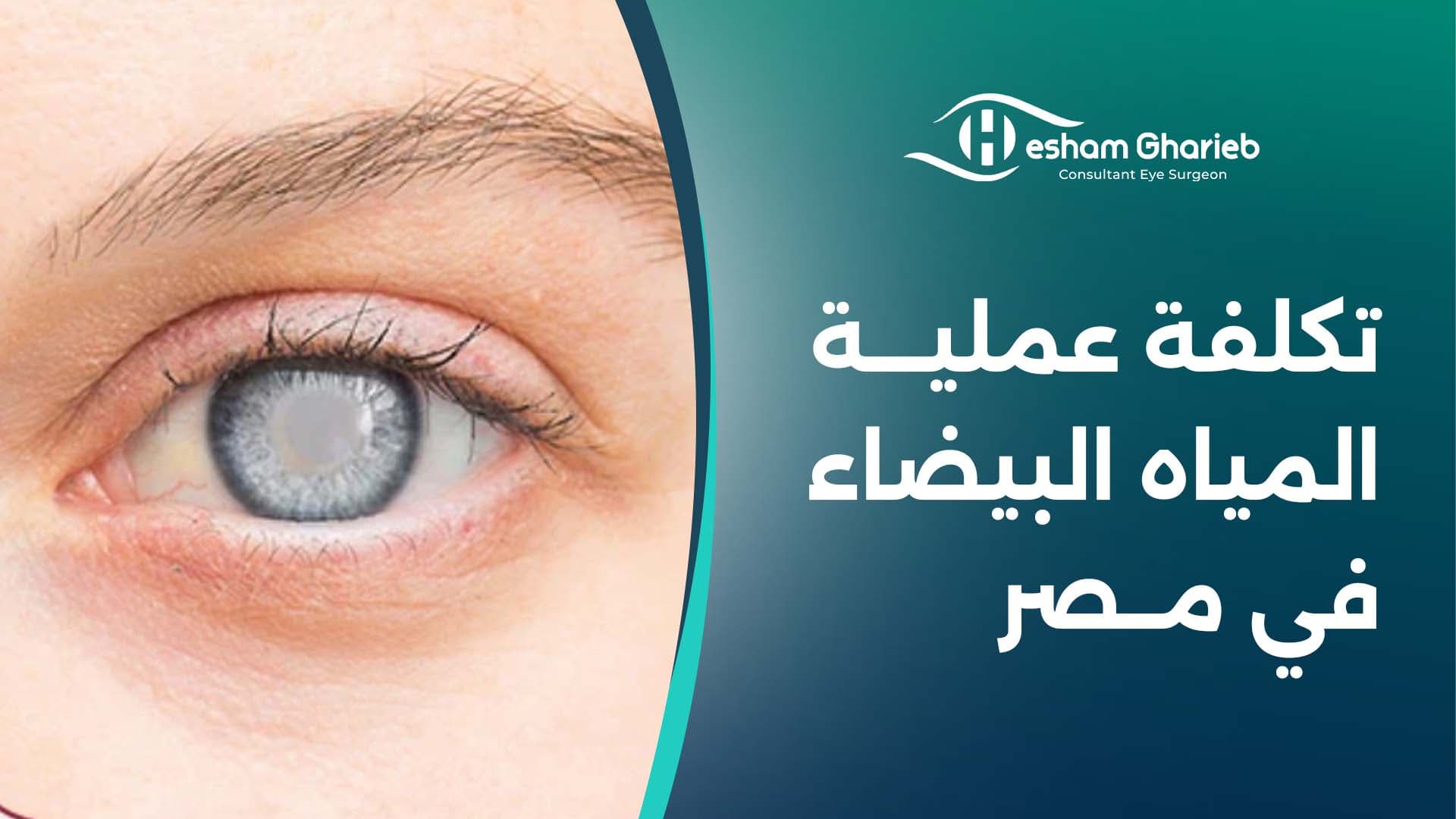 تكلفة عملية المياه البيضاء في مصر – تفاصيل و أسعار