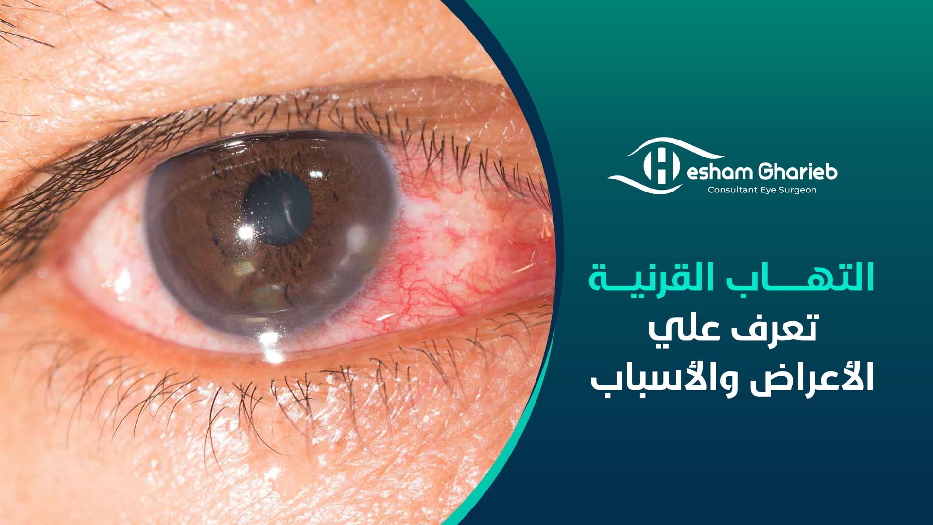التهاب القرنية – تعرف علي الأعراض والأسباب