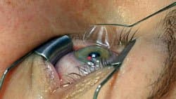 Micro-keratome LASIK
