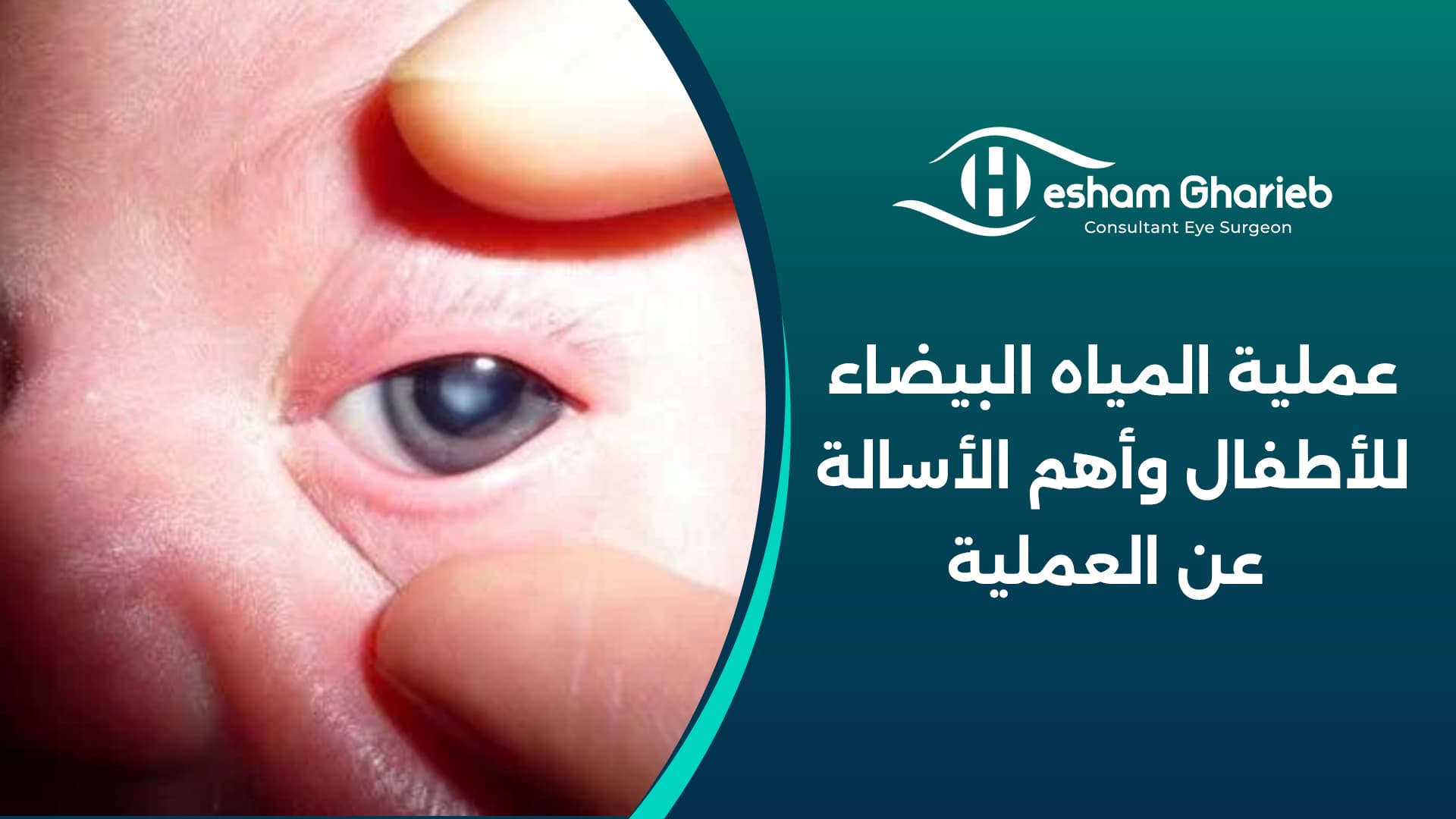 عملية المياه البيضاء للأطفال وأهم الأسالة عن العملية