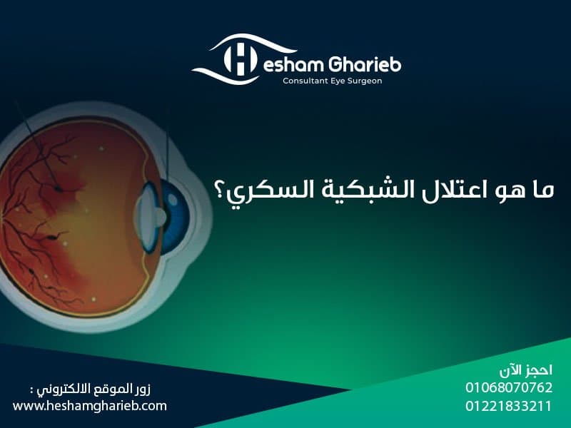 ما هو اعتلال الشبكية السكري؟ | علاج تلف الشبكية بسبب السكر في مصر