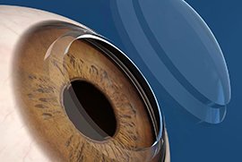 زراعة القرنية 01