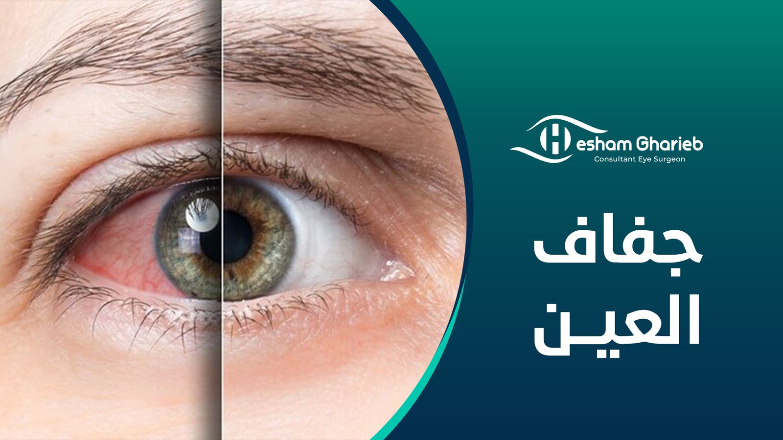 جفاف العين جفاف العين