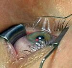 Micro-keratome LASIK