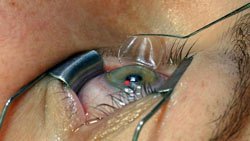 Femto LASIK vs. SMILE Surgery in Egypt