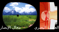 Glaucoma-progression-Arabic