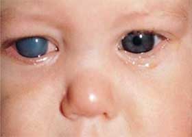 Glaucoma In Children