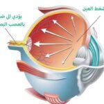 ما هو الجلوكوما: أسئلة و أجوبة يجرب معرفتها