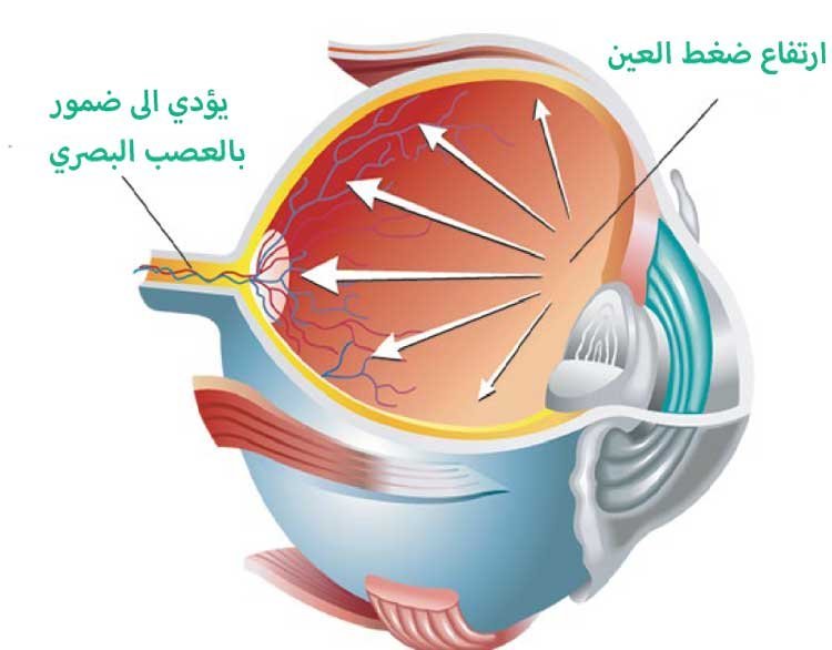 ما هو الجلوكوما: أسئلة و أجوبة يجرب معرفتها