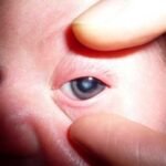 Cataract in Children