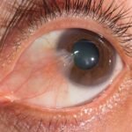 Pterygium