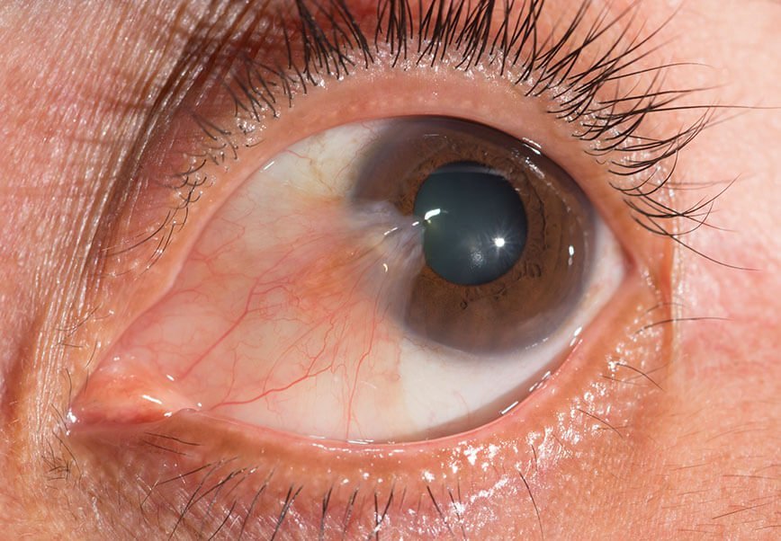 Pterygium