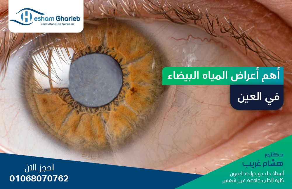 أهم أعراض المياه البيضاء في العين