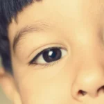 تكلفة زراعة القرنية للأطفال – كم سعر عملية زراعة القرنية للأطفال