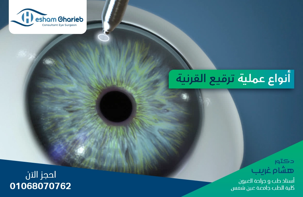 دليلك الشامل عن عملية ترقيع (زرع) القرنية