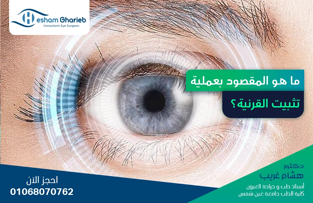 ما هو المقصود بعملية تثبيت القرنية؟