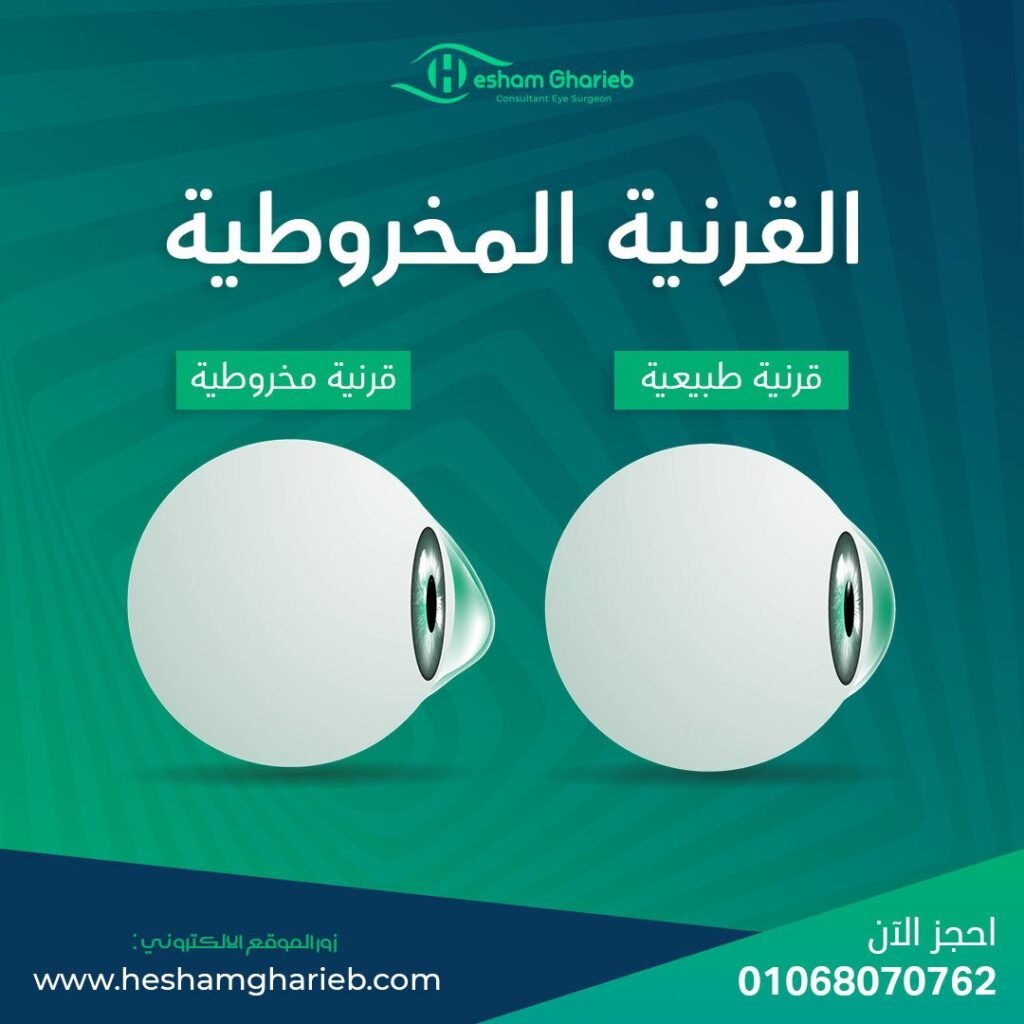 الليزر السطحي للقرنية المخروطية مع دكتور هشام غريب