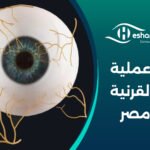 تكلفة عملية ترقيع القرنية في مصر – سعر عملية ترقيع القرنية