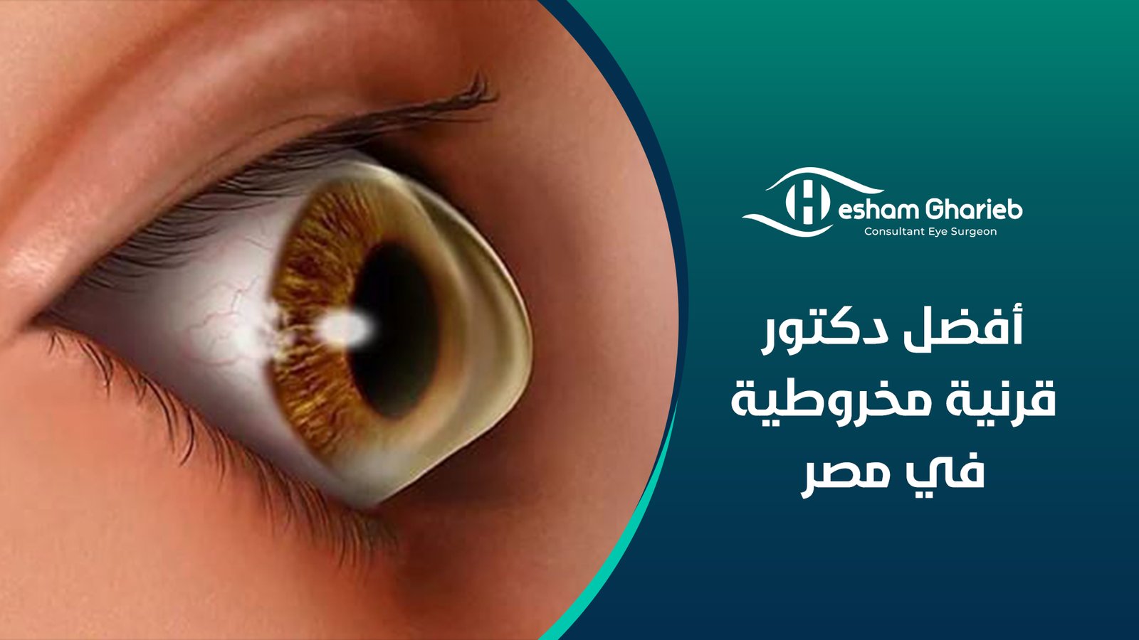 أفضل دكتور قرنية مخروطية في مصر