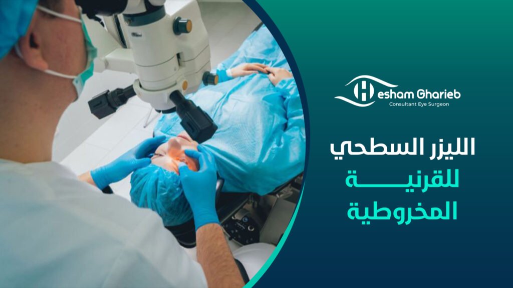 الليزر السطحي للقرنية المخروطية