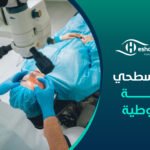 الليزر السطحي للقرنية المخروطية