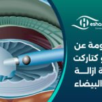 12 معلومة عن الفيمتو كتاركت و عملية ازالة المياه البيضاء