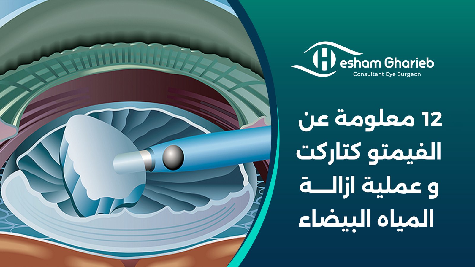 12 معلومة عن الفيمتو كتاركت و عملية ازالة المياه البيضاء