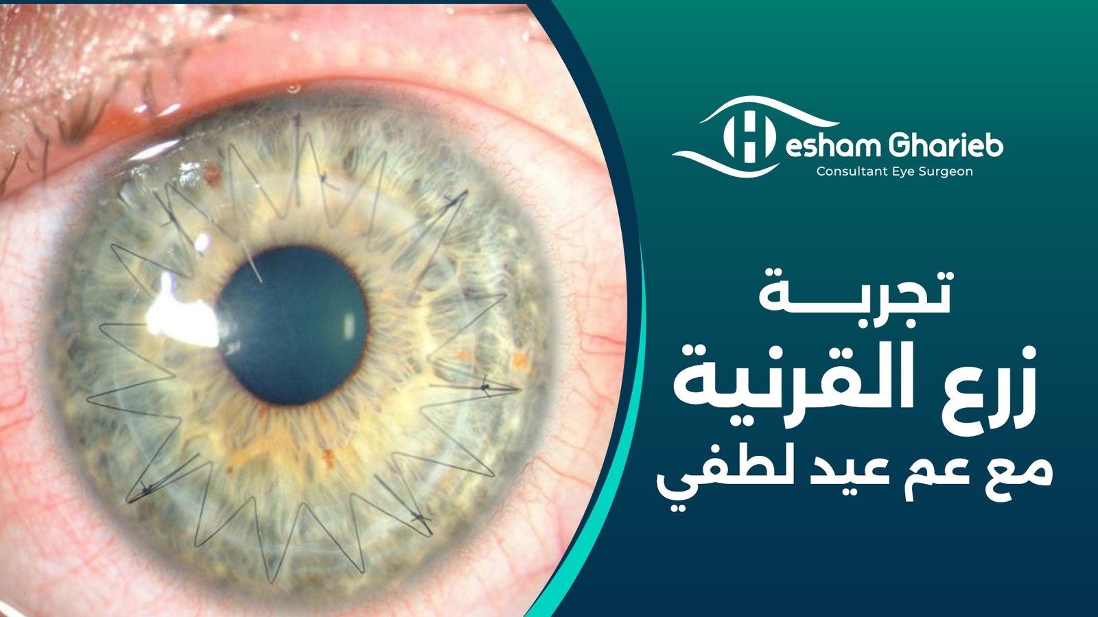 تجربة زرع القرنية مع عم عيد لطفي تجربة زرع القرنية مع عم عيد لطفي