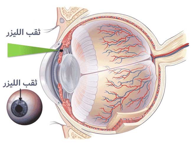 علاج الجلوكوما بالليزر