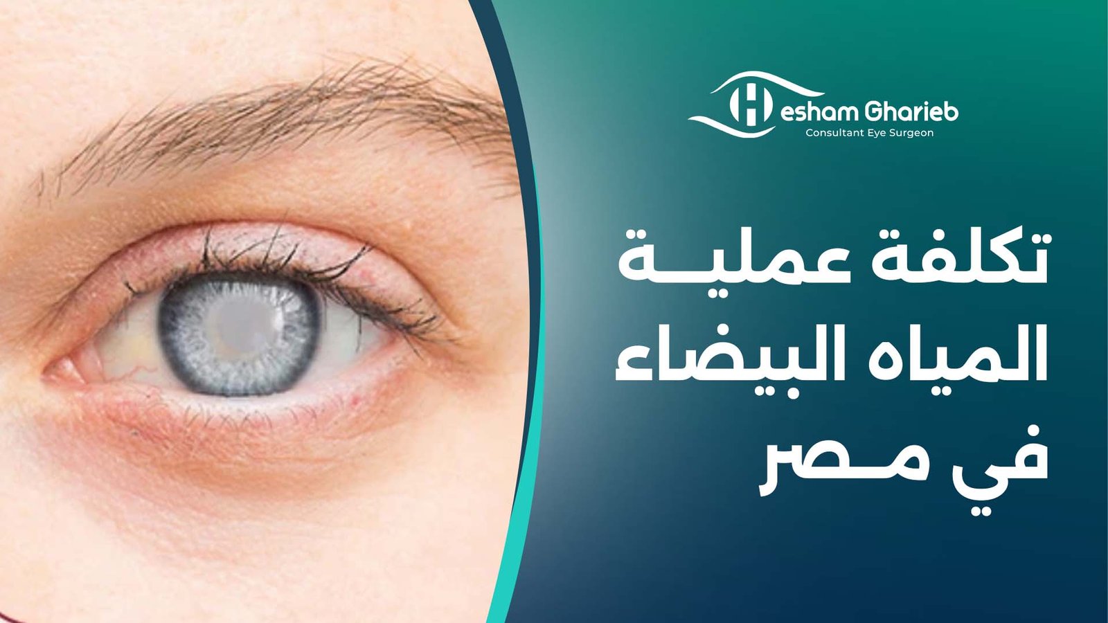 تكلفة عملية المياه البيضاء في مصر