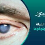 ما هي المياة الزرقاء الجلوكوما