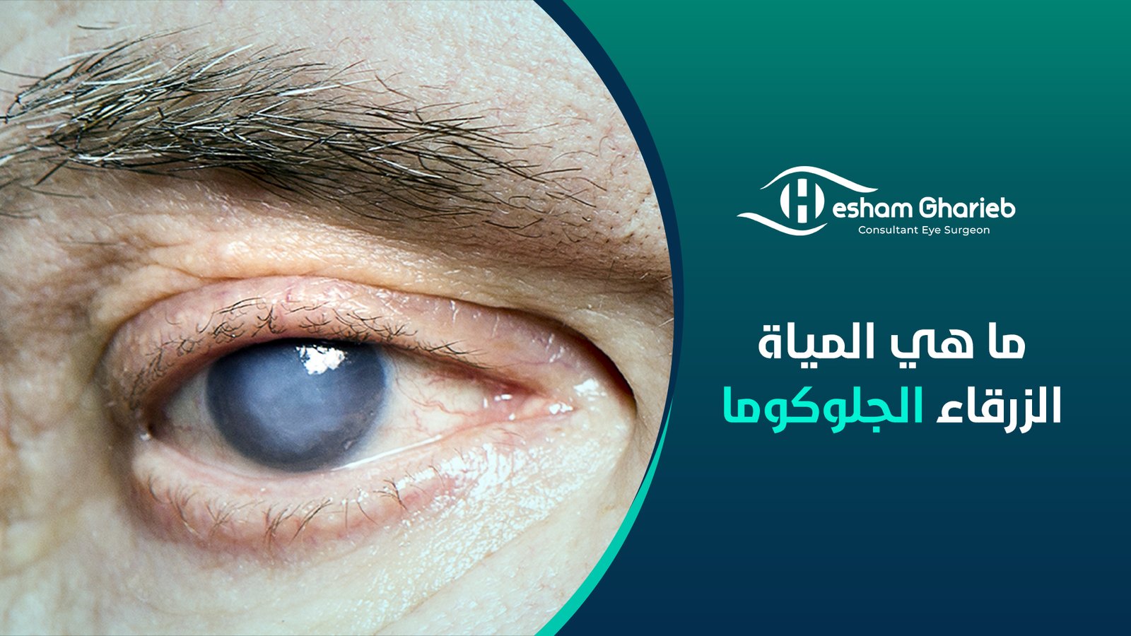 ما هي المياة الزرقاء الجلوكوما