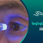 علاج الجلوكوما بالليزر
