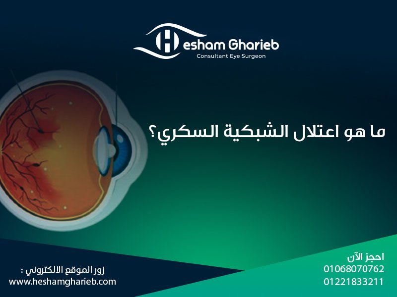 ما هو اعتلال الشبكية السكري؟ | علاج تلف الشبكية بسبب السكر في مصر