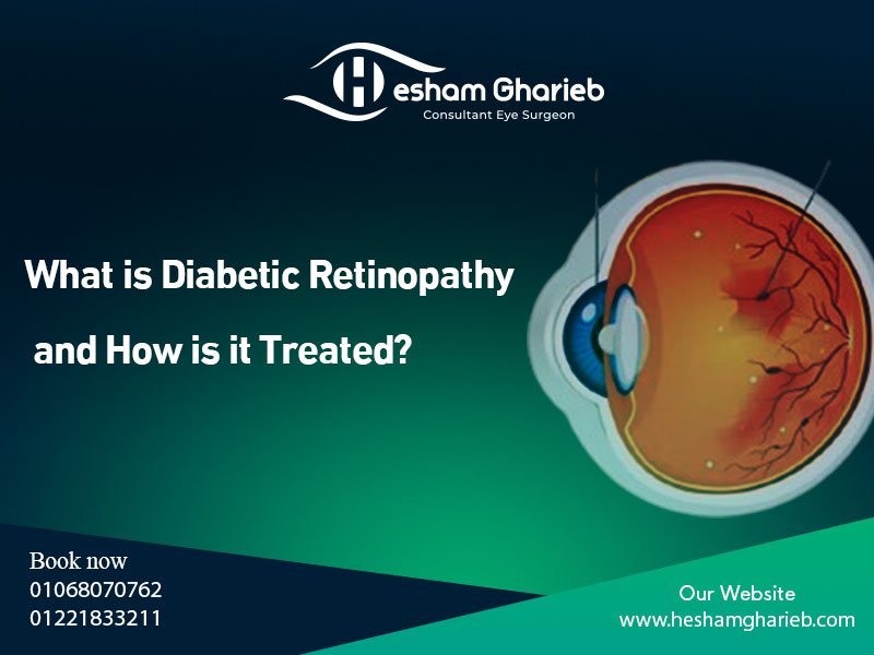 What is Diabetic Retinopathy? Symptoms & Treatment Options