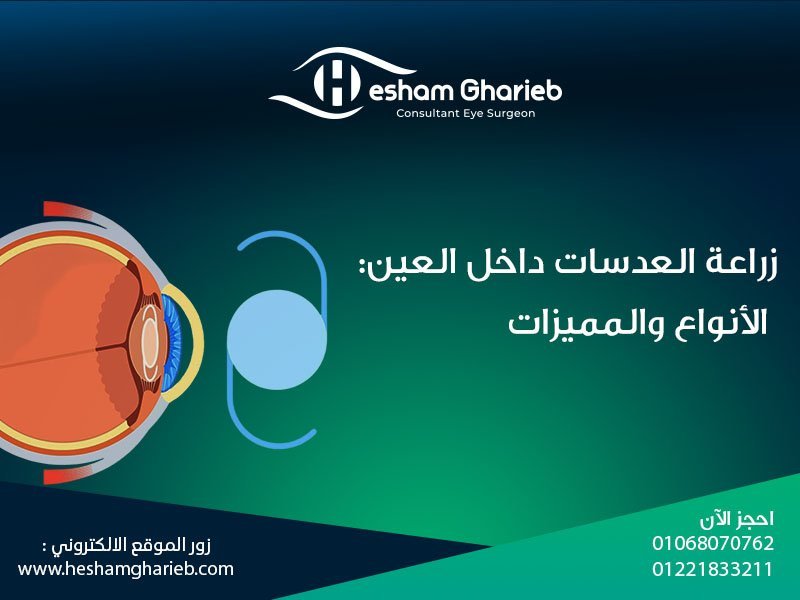 زراعة العدسات داخل العين: الأنواع والفوائد لتصحيح النظر بدون ليزك في مصر