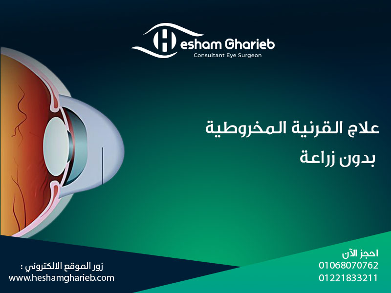 علاج القرنية المخروطية بدون زراعة: 3 خيارات آمنة وفعالة لراحة نظرك زيارة طبيب العيون