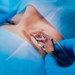 Lasik: Frequent Questions